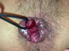 内痔核を縛り上げて引き回す